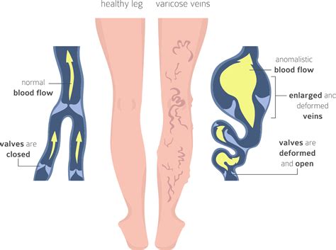 Varicose Vein Treatment - CLI Vascular Specialists