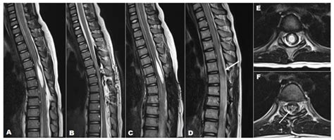 Optimizing Therapeutic Strategies for Syringomyelia Associated with ...