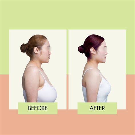 Best Breast Reduction Surgeon In Las Vegas