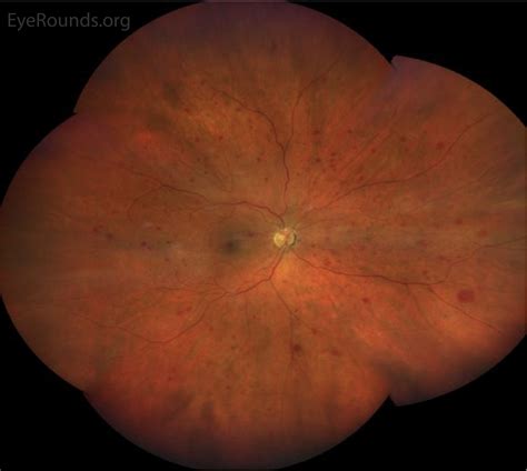 EyeRounds.org: Ocular Ischemic Syndrome