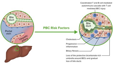 Primary Biliary Cholangitis (Clinical) | Concise Medical Knowledge