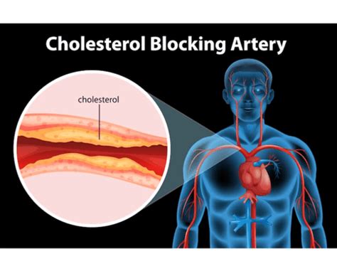 High Cholesterol Level: Know Types, Causes, Symptoms and Health Risks
