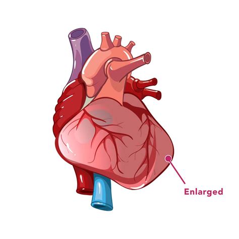 #DefyHeartFailure - CVSKL | Heart Failure Awareness