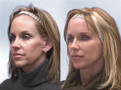 Sculptra Before and After | Robinson FPS