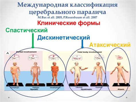 Формы ДЦП | Справка.Неинвалид.ru