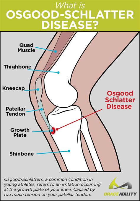 Osgood Schlatter Surgery | Osgood-Schlatter's Disease Adults Procedure