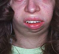 Image result for Micrognathia