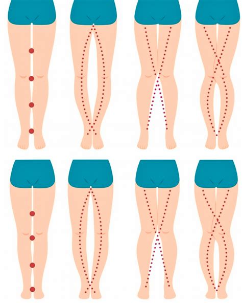 Image result for Leg Alignment