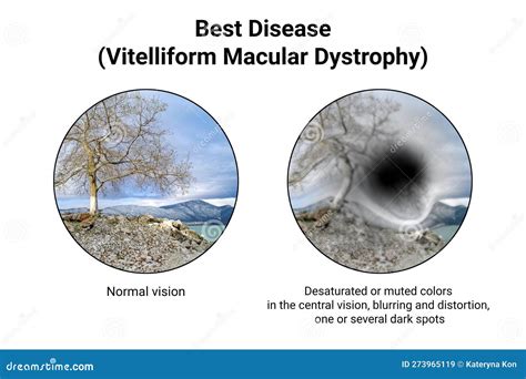Normal Eye Vision 的图像结果