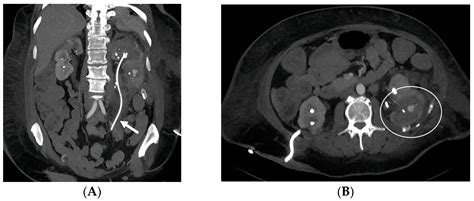 Complications Subsequent to Urinary Tract Stent Placement: An Overview Focusing on the Imaging ...
