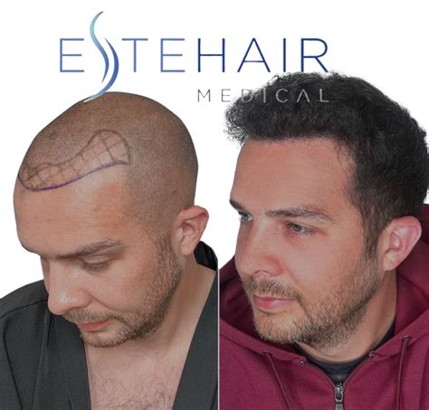 Exosome Hair Loss Treatment - Este Hair Medical
