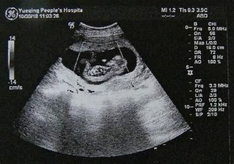 7个明显或不明显的胎停育前兆，孕妈一定要留意！_凤凰网健康_凤凰网