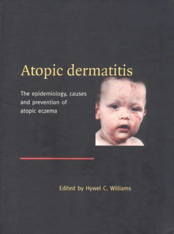 Buy Atopic Dermatitis: The Epidemiology, Causes and Prevention of ...