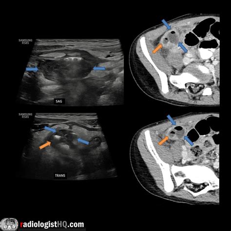Perforated appendicitis on ultrasound & CT : r/Radiology