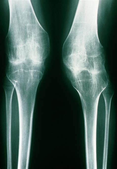 X-ray Of Knees Juvenile Arthritis Photograph by Medical Photo Nhs ...