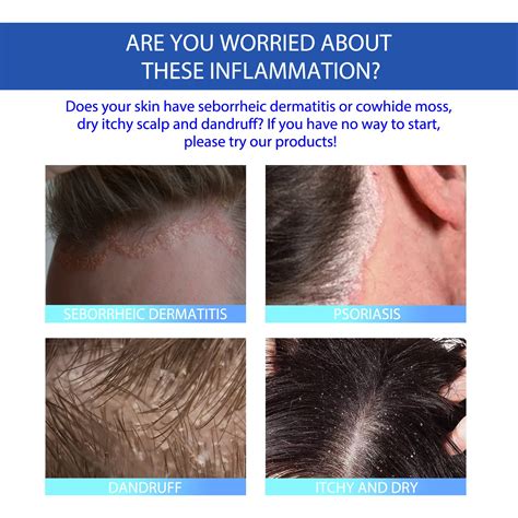 Dandruff Vs Seborrheic Dermatitis