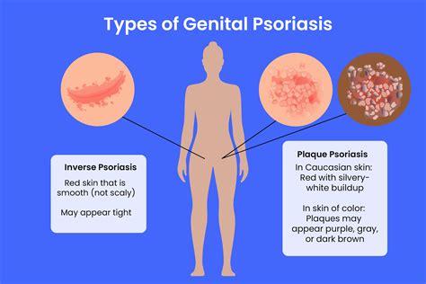 What Causes Dry Flaky Skin On Penile Shaft - Infoupdate.org