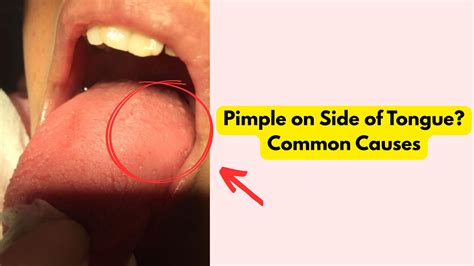 Pimple on Side of Tongue: When to Worry (and When Not To)