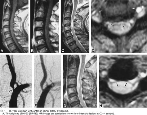 Anterior Cord Syndrome Vertebral Artery