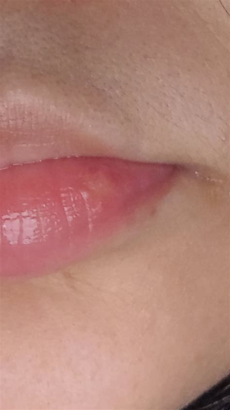 Canker sore or cold sore?? : r/CankerSores
