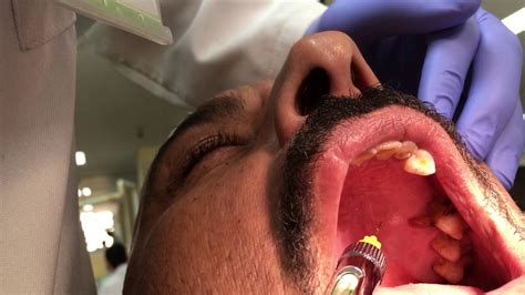 Extraoral Technique of Local Anesthesia 的图像结果
