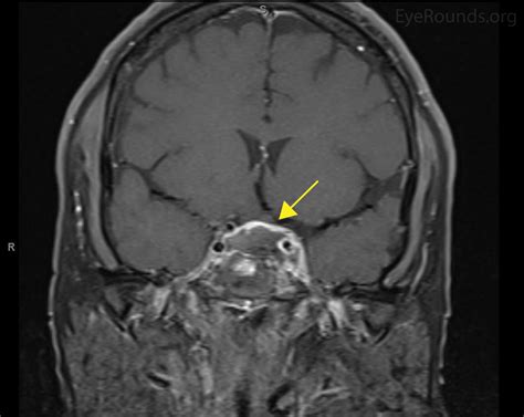 Dsd Cavernous Sinus Syndrome