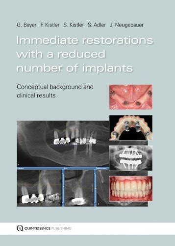 Buy Immediate Restorations with a Reduced Number of Implants ...