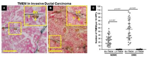 Tumor Microenvironment of Metastasis (TMEM) Doorways Are Restricted to ...