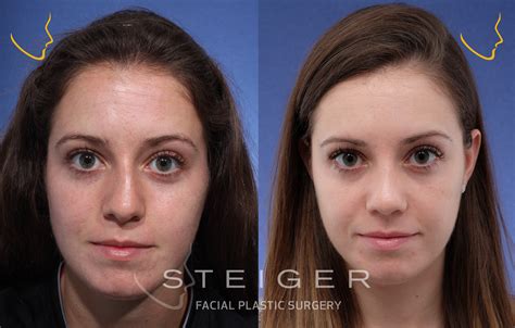 Nose Job Before And After Women Patient #6300 Rhinoplasty African