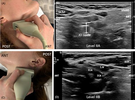 Sonographic localisation of neck lymph nodes using surgical neck level classifications - Fenech ...