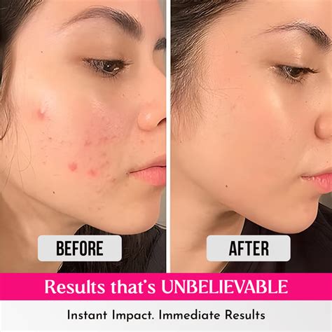 Buy Korean Pimple Patches for Face at Best Price in India - Wildglow