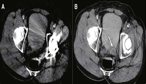 CT Scan 的图像结果