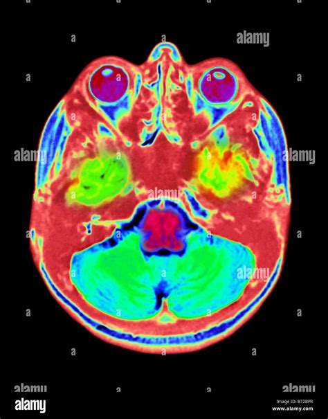 MRI scan of the brain Stock Photo - Alamy