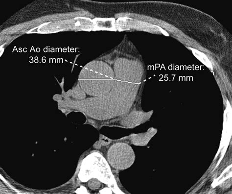 Reference Values for Normal Pulmonary Artery Dimensions by Noncontrast Cardiac Computed ...