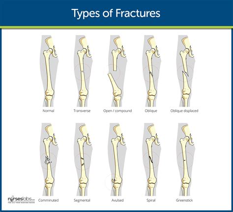 Fracture Nursing Care Management: Study Guide