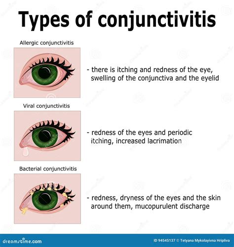 Bacterial Conjunctivitis