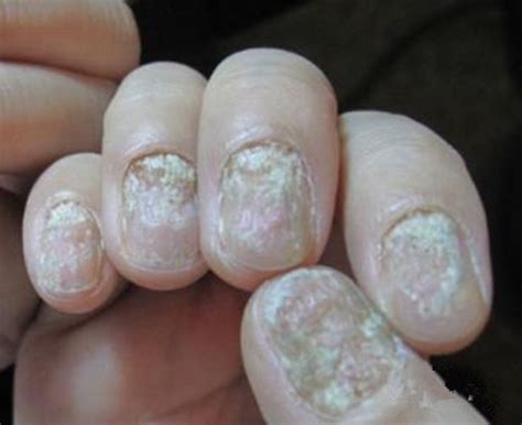 灰指甲的初期症状-灰指甲症状-复禾健康
