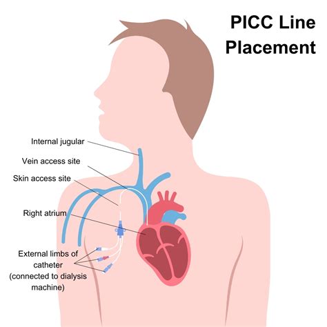 Picc Line Neck Peripherally Inserted Central Catheter (PICC) — The