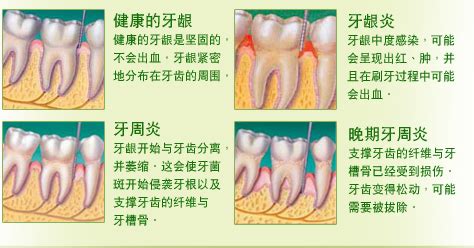 牙髓炎产生的四大原因，你知道几个？ - 知乎