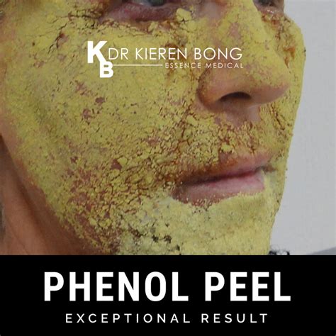 Phenol Chemical Skin Deep Peel | Glasgow