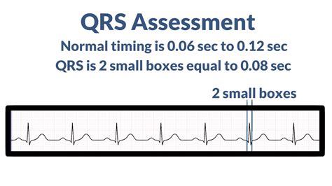 Interpreting ECG Strips – Nursing Unraveled