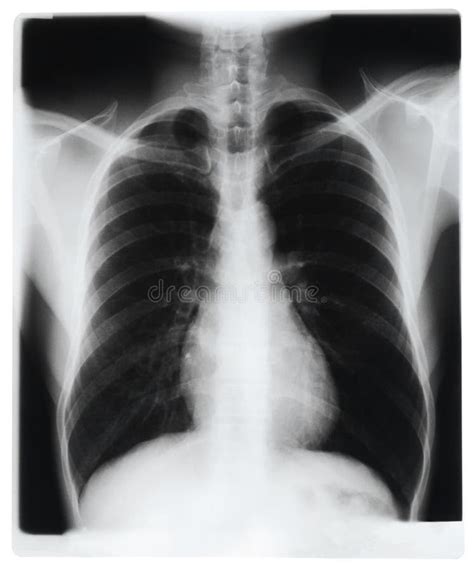 Hospital X-ray Chest 的图像结果