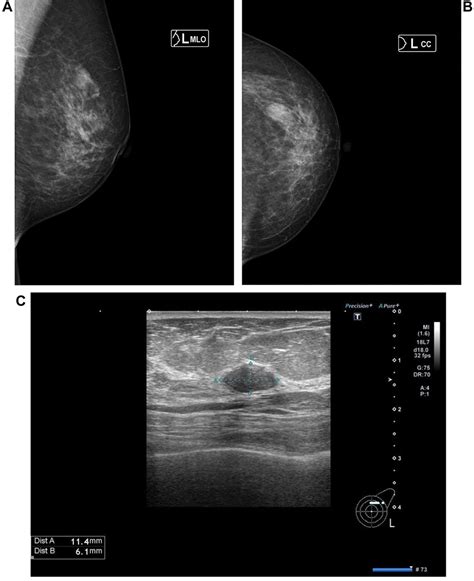 Cancer Lymph Node On Mammogram Finding Cancer In Mammograms: If You