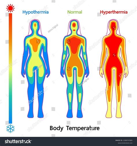 What Is A Hypothermic Body Temperature at Willard Madrigal blog