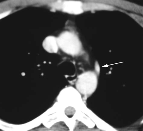Azygos Vein Ct Corona