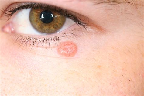 Basal Cell Carcinoma - Dermatology Advisor