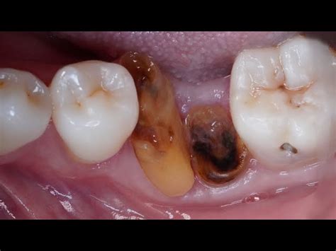 Image result for Abscess Explosion