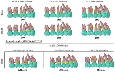 Upper First Molar and Second Premolar Distalization with Clear Aligner ...