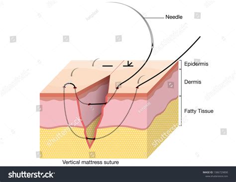 Vertical Mattress Suture Technique Discounted Outlet | www.pinnaxis.com