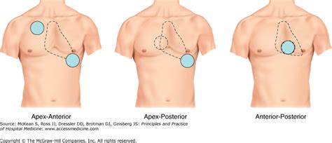 Image result for Synchronized Cardioversion Lead Placement